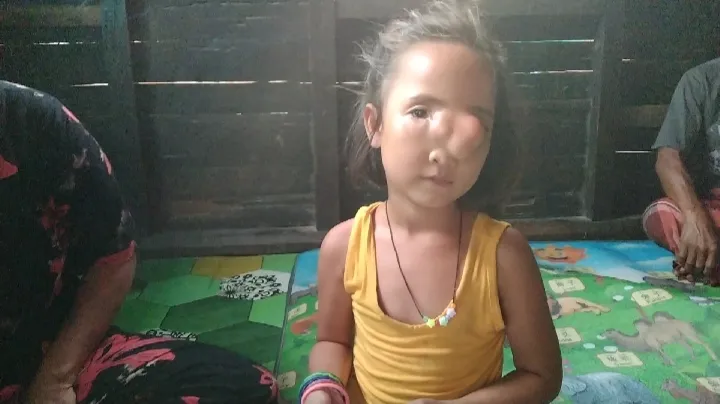 Nasib Gadis Cilik Simangambat Butuh Bantuan