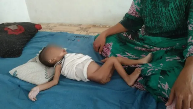 Bocah Panyabungan Gizi Buruk