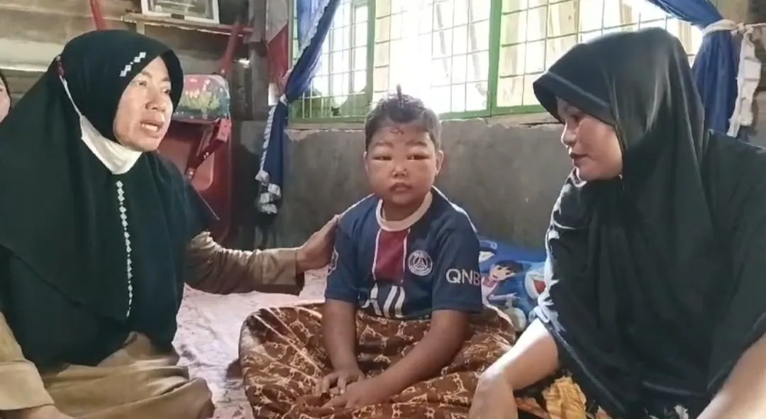 Bocah Penderita Ginjal Bocor Butuh 'Uluran Tangan' Dermawan