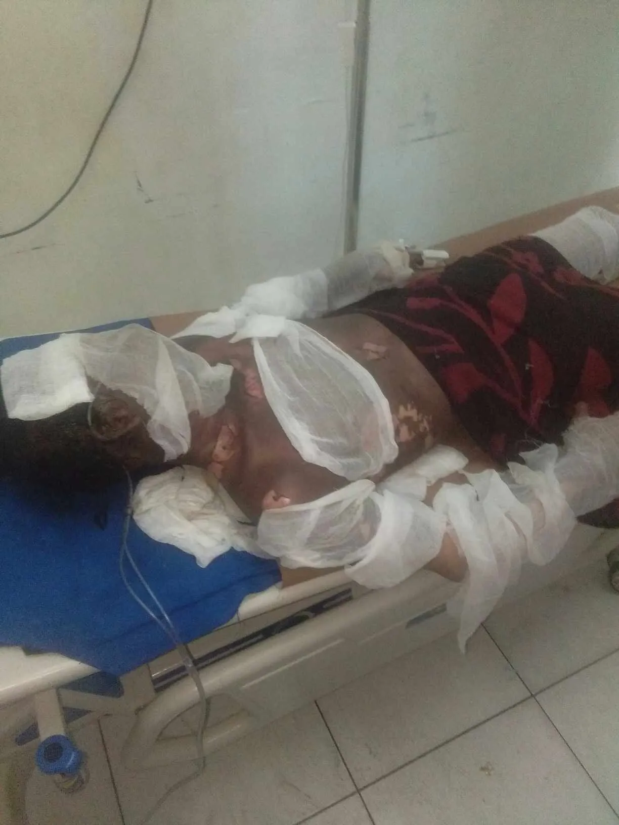 Dituduh Curi Hp, Deni Kritis Dibakar Di Perumnas Mandala
