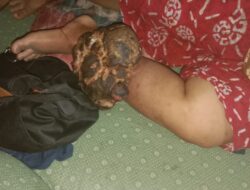 Ibu Yusniarti Pasrah, Tiga Tahun Menderita Tumor Ganas di Kaki