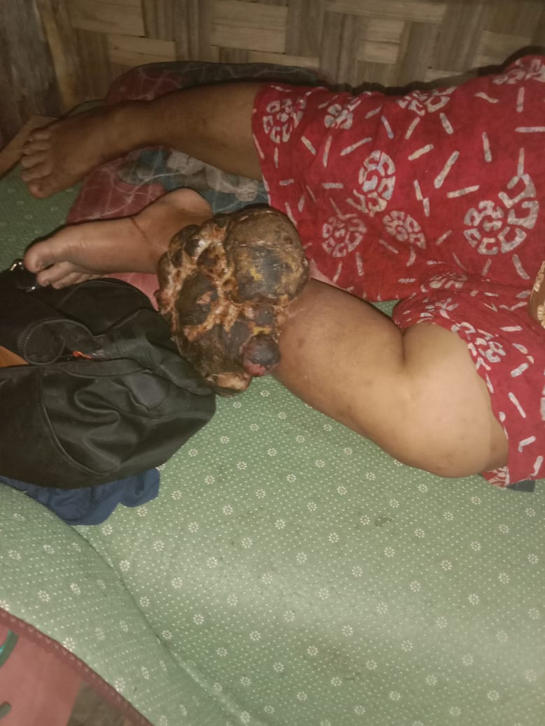 Yusniarti (43) warga Dusun I Desa Perupuk Kecamatan Datuk Limapuluh Pesisir Kabupaten Batu Bara, mengidap kanker Tumor ganas di kaki , Kamis (03/11/2022).beritasore/alirsyah