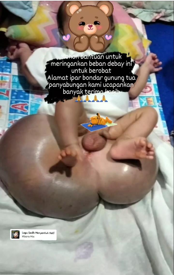 Teks foto berita/Ist Bayi laki-laki asal Desa Iparbondar Gunungtua, Kec. Panyabungan, menderita spina bifida (cacat lahir, sumsum tulang belakang bayi gagal berkembang)