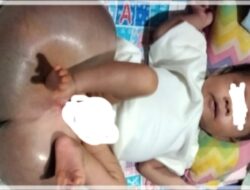 Teks fotoBerita/ist
Bayi Saddam mengidap spina bifida, penyakit langka, yang sudah dirujuk ke RSUP H. Adam Malik, Medan.