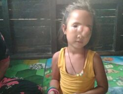 Nasib Gadis Cilik Simangambat  Butuh Bantuan