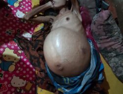 3 Penderita Akut Di Madina, Kades Diminta Maksimalkan Pendataan