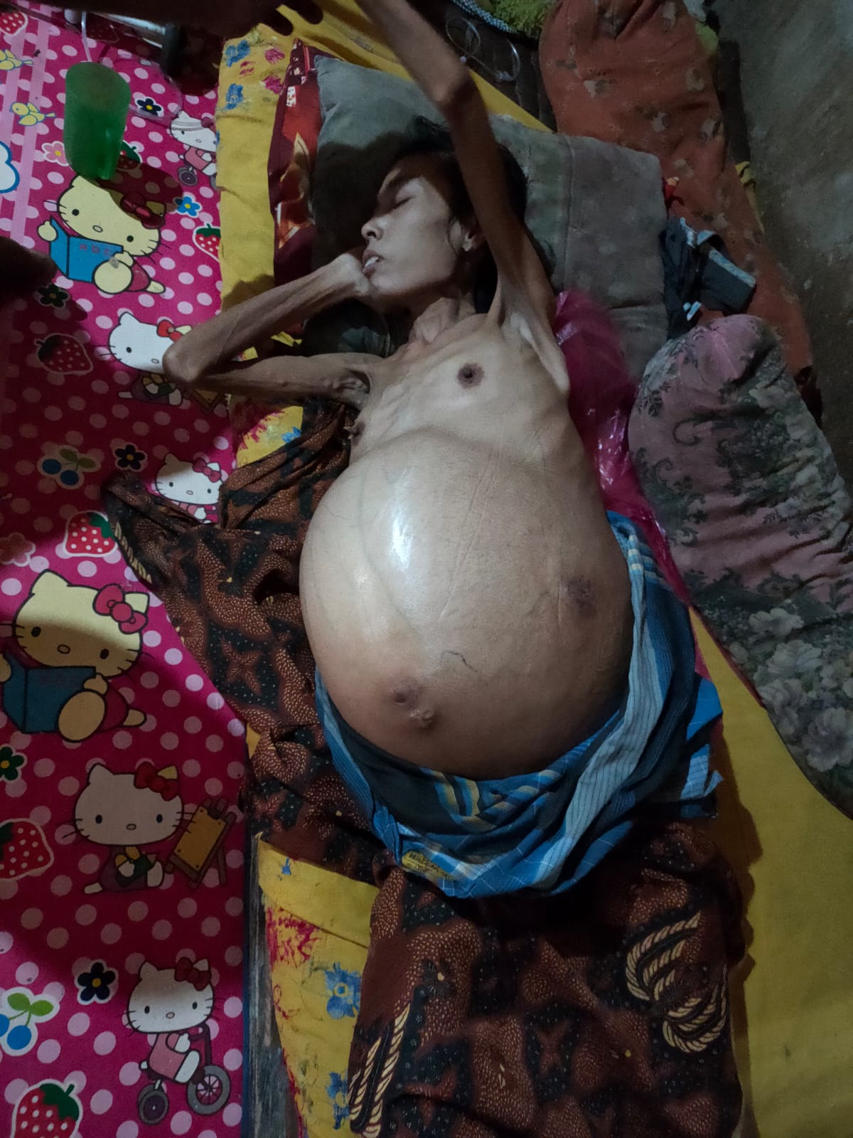 Teks foto Berita/ist Sawiyah, 40, warga Desa Gading Bain, Kec. Kotanopan, Kab. Mandailing Natal, menderita sirosis hepatitis, dalam kondisi sangat lemah, perut membesar.